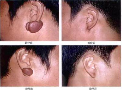 跟瘢痕疙瘩、皮膚血管瘤說拜拜--放射性核素敷貼治療